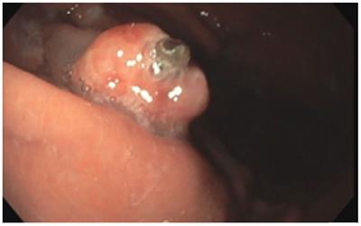 Case report: Uncommon gastric metastasis as a presentation of recurrent clear cell renal cell carcinoma